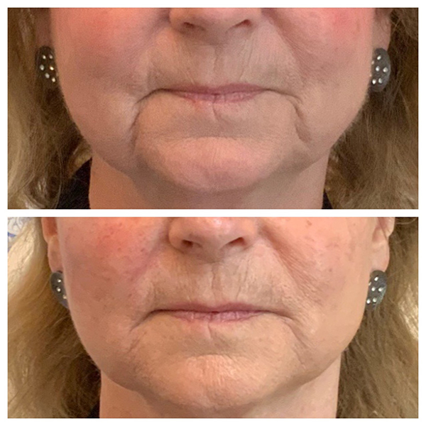Patient 27018964 Lines Before & After Photos Saving Face
