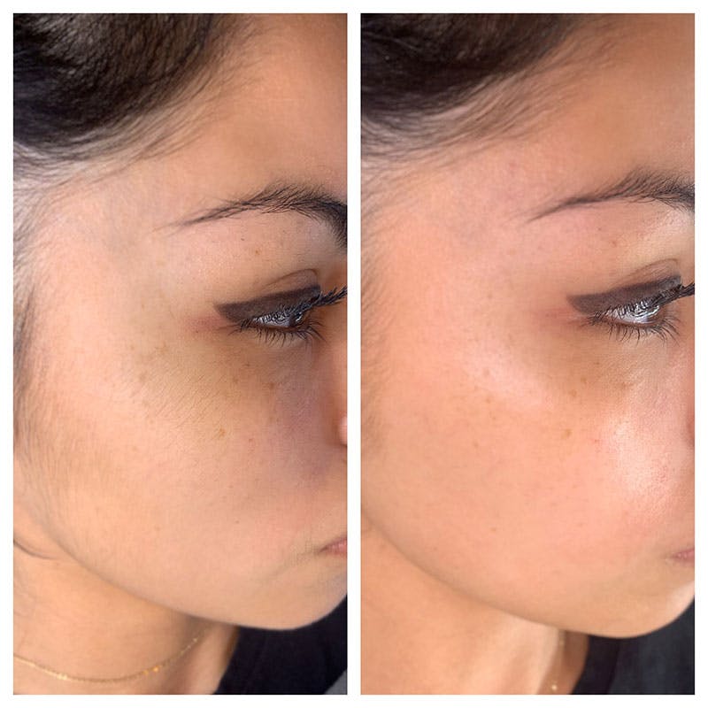 Dermaplane Before & After Gallery - Patient 27018965 - Image 1