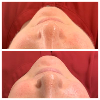 Dermaplane Before & After Gallery - Patient 27018966 - Image 1