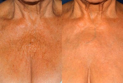 IPL Before & After Gallery - Patient 27018968 - Image 1