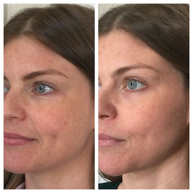 IPL Before & After Gallery - Patient 27018969 - Image 1