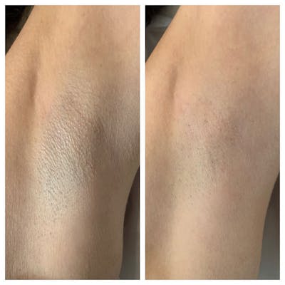 Laser Hair Removal Before & After Gallery - Patient 27018972 - Image 1