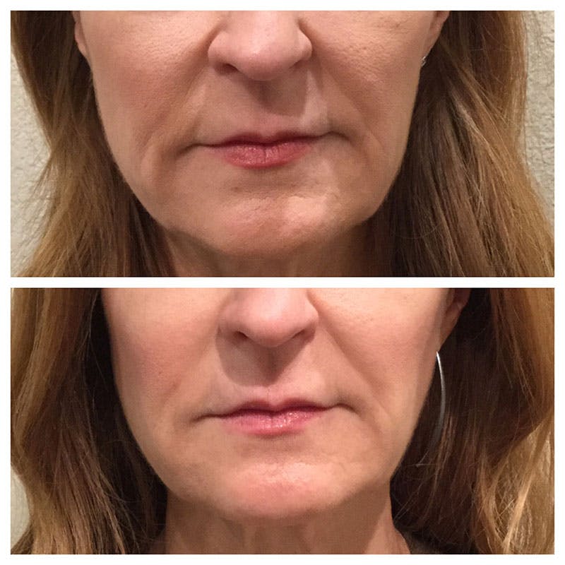 Ultherapy Before & After Gallery - Patient 27019010 - Image 1