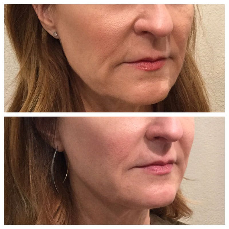 Ultherapy Before & After Gallery - Patient 27019010 - Image 2