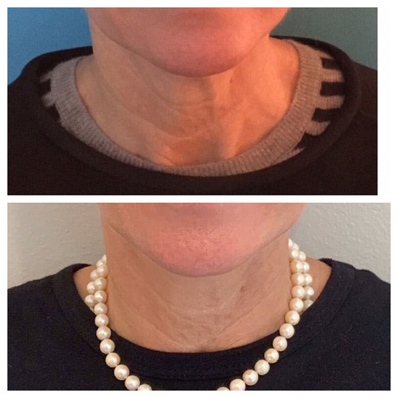 Ultherapy Before & After Gallery - Patient 27019011 - Image 1