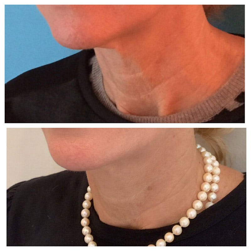 Ultherapy Before & After Gallery - Patient 27019011 - Image 2