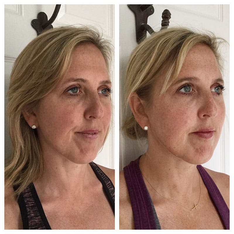 Ultherapy Before & After Gallery - Patient 27019012 - Image 1
