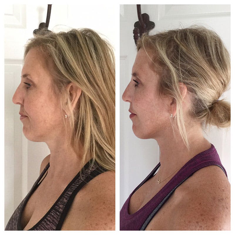 Ultherapy Before & After Gallery - Patient 27019012 - Image 2