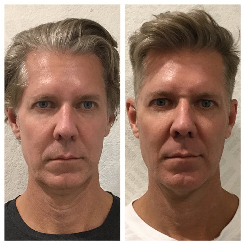 Ultherapy Before & After Gallery - Patient 27019013 - Image 1
