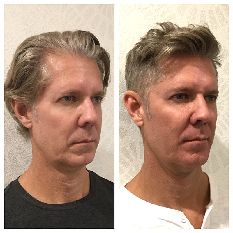Ultherapy Before & After Gallery - Patient 27019013 - Image 2