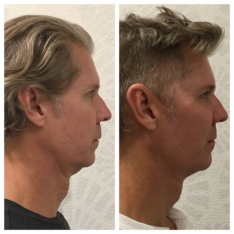 Ultherapy Before & After Gallery - Patient 27019013 - Image 3