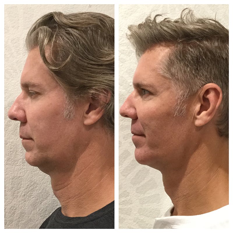 Ultherapy Before & After Gallery - Patient 27019013 - Image 4