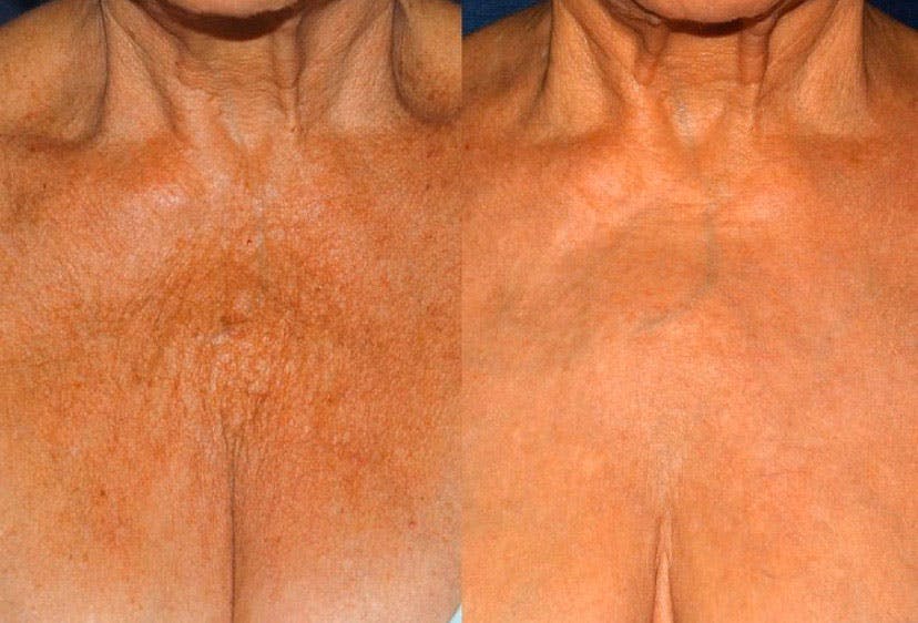 Ultherapy Before & After Gallery - Patient 27019014 - Image 1