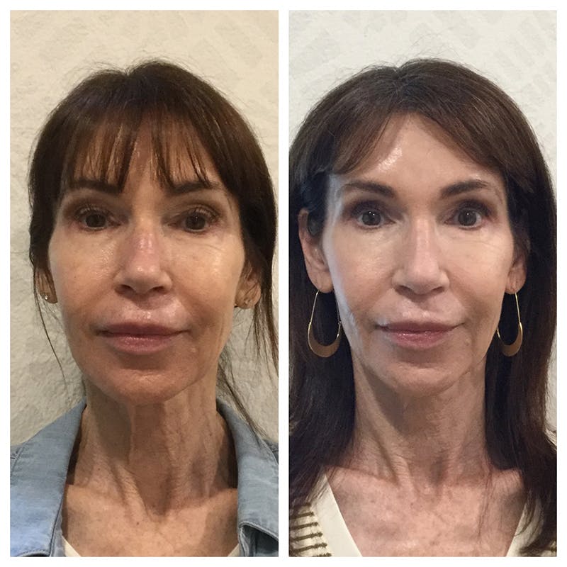 Ultherapy Before & After Gallery - Patient 27019016 - Image 1