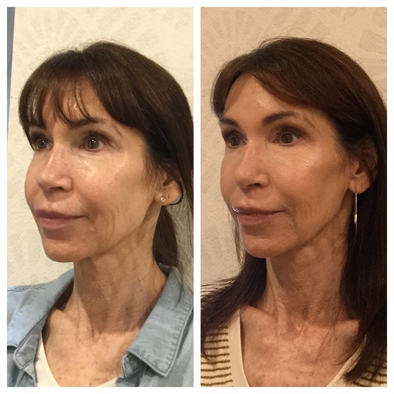 Ultherapy Before & After Gallery - Patient 27019016 - Image 2