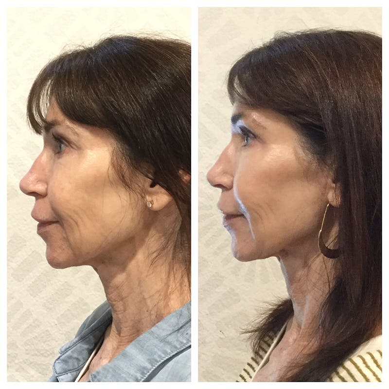 Ultherapy Before & After Gallery - Patient 27019016 - Image 3