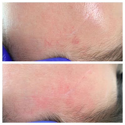 Vein Treatment Before & After Gallery - Patient 27019015 - Image 1