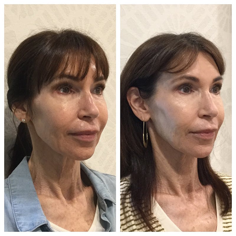 Ultherapy Before & After Gallery - Patient 27019016 - Image 4