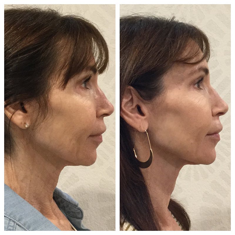 Ultherapy Before & After Gallery - Patient 27019016 - Image 5
