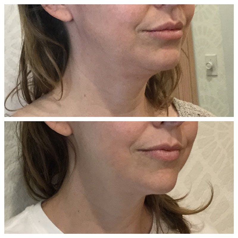 Ultherapy Before & After Gallery - Patient 27019017 - Image 1