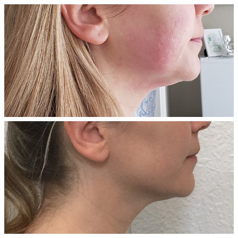 Ultherapy Before & After Gallery - Patient 27019017 - Image 2