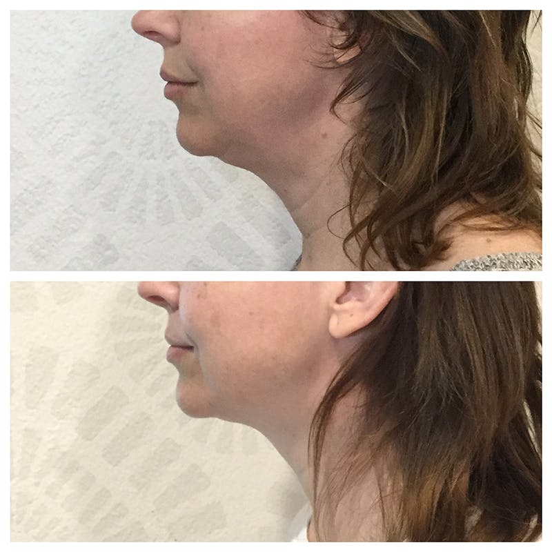 Ultherapy Before & After Gallery - Patient 27019017 - Image 3
