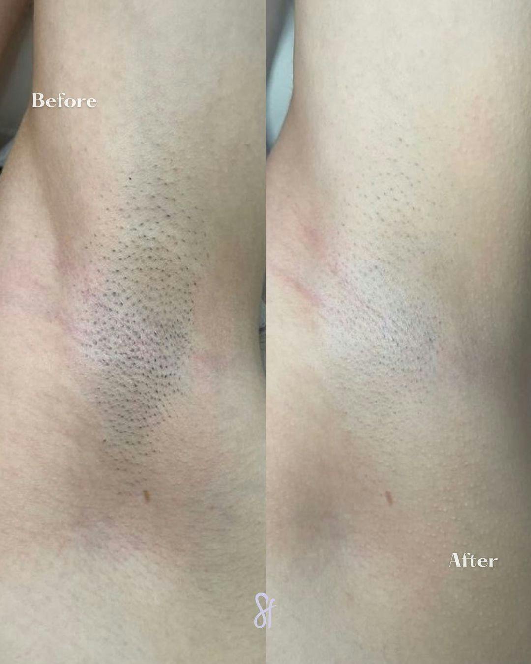Laser Hair Removal Before & After Gallery - Patient 130253904 - Image 1