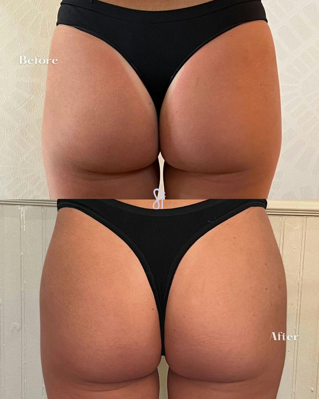 Patient 133820252, Non-Surgical BBL Before & After Photos