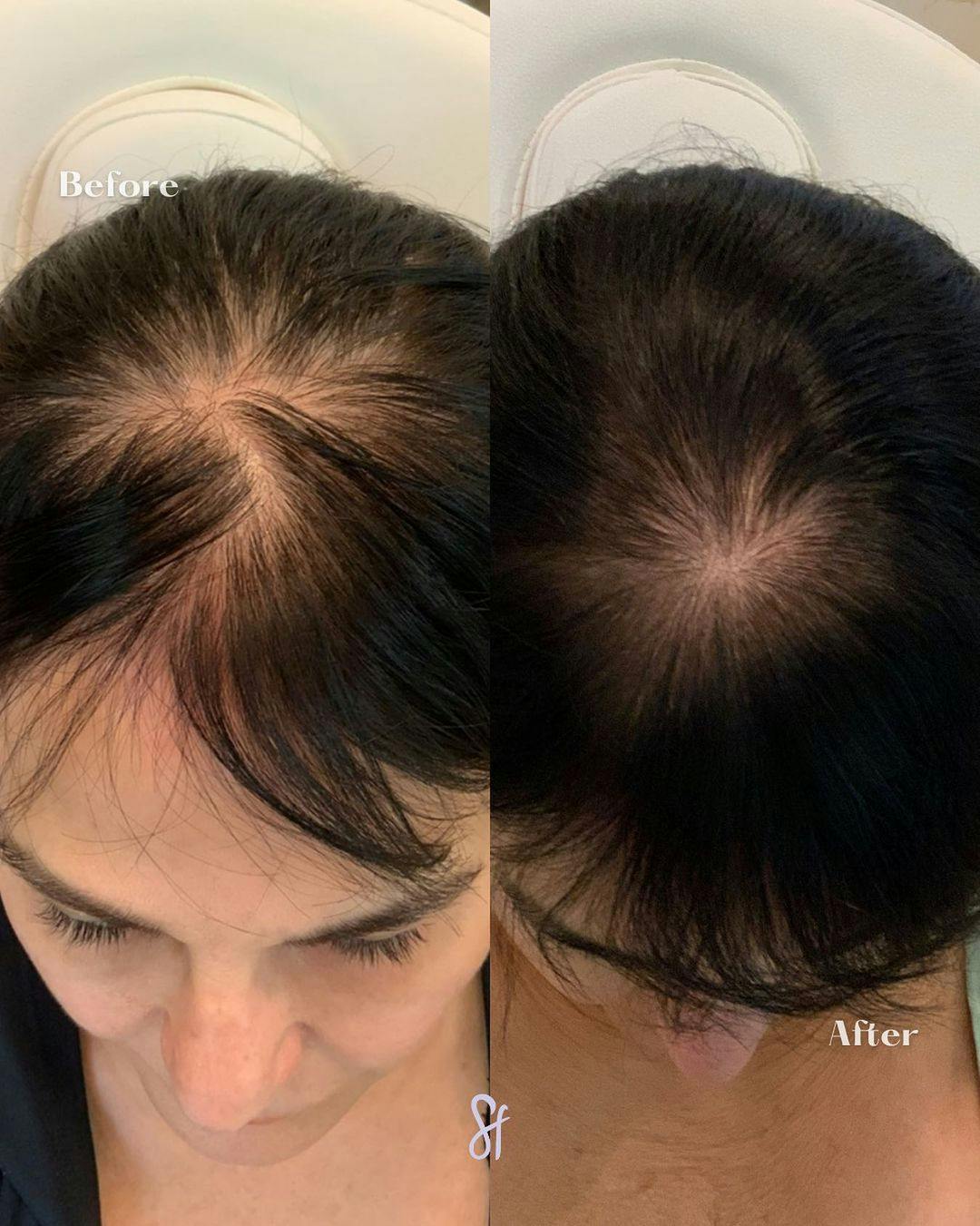 Hair Restoration  Before & After Gallery - Patient 133835300 - Image 1