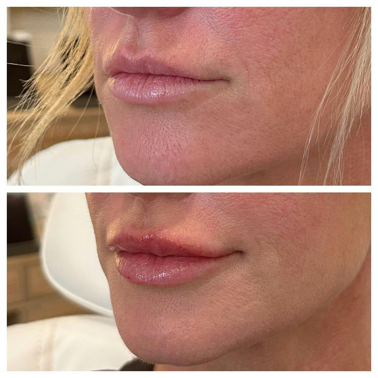 Lips Before & After Gallery - Patient 133835302 - Image 2