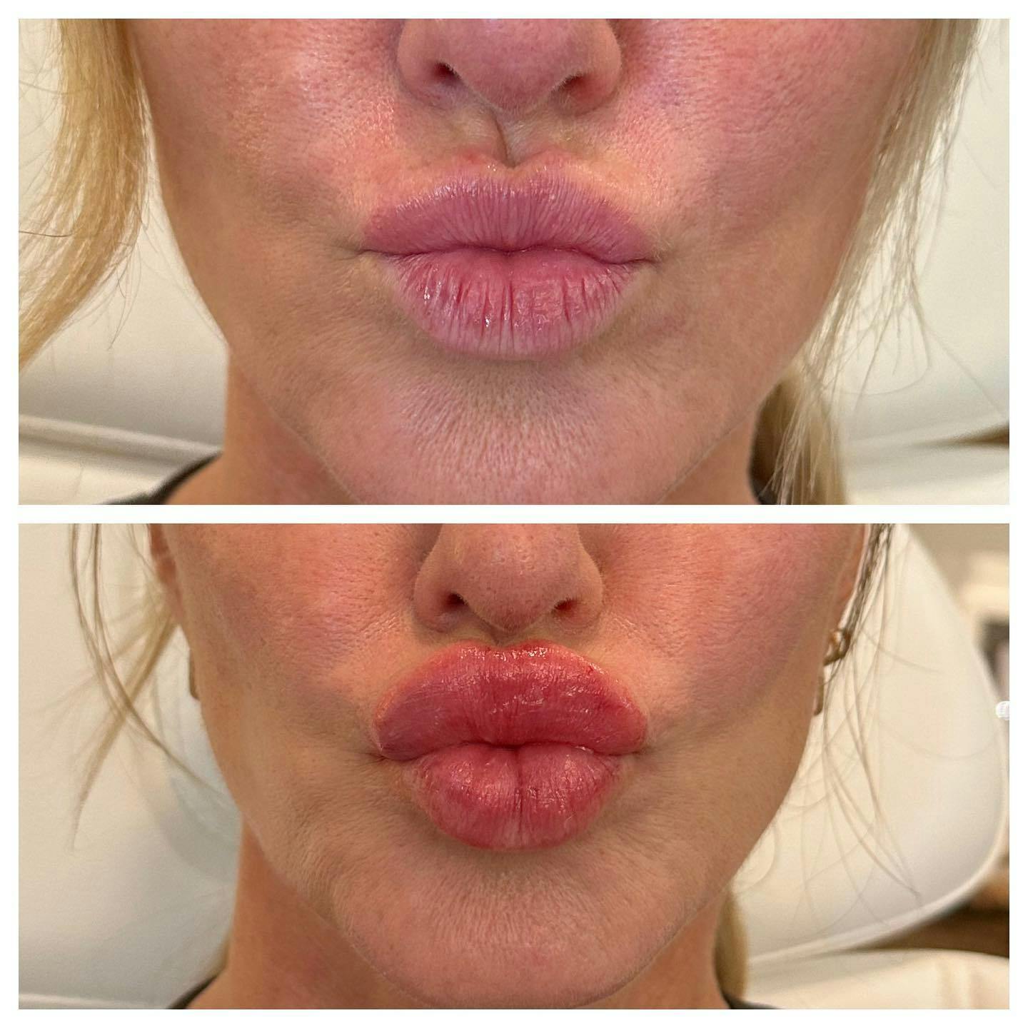 Lips Before & After Gallery - Patient 133835302 - Image 3