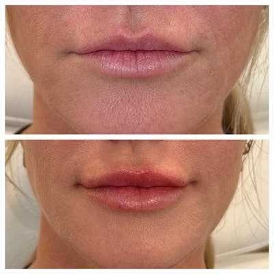 Lips Before & After Gallery - Patient 133835302 - Image 1