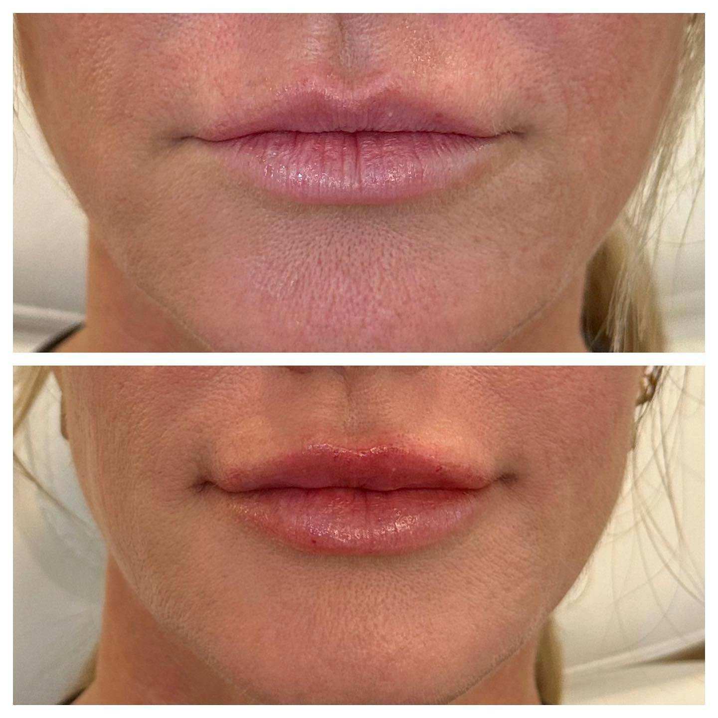 Lips Before & After Gallery - Patient 133835302 - Image 1