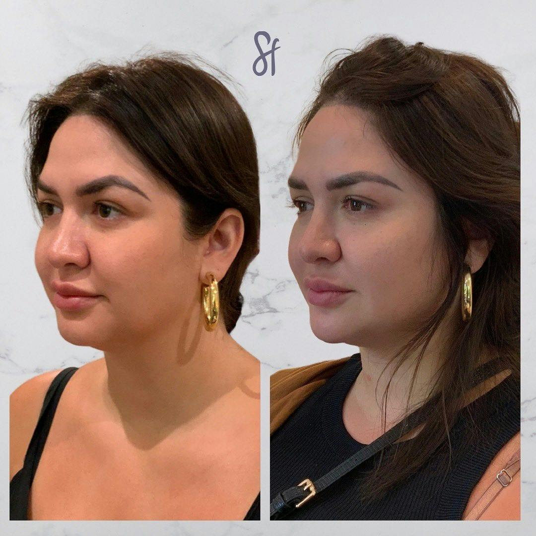 Facial Rejuvenation  Before & After Gallery - Patient 133835324 - Image 2