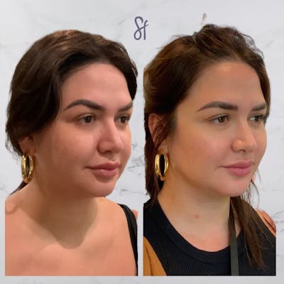 Facial Rejuvenation  Before & After Gallery - Patient 133835324 - Image 1