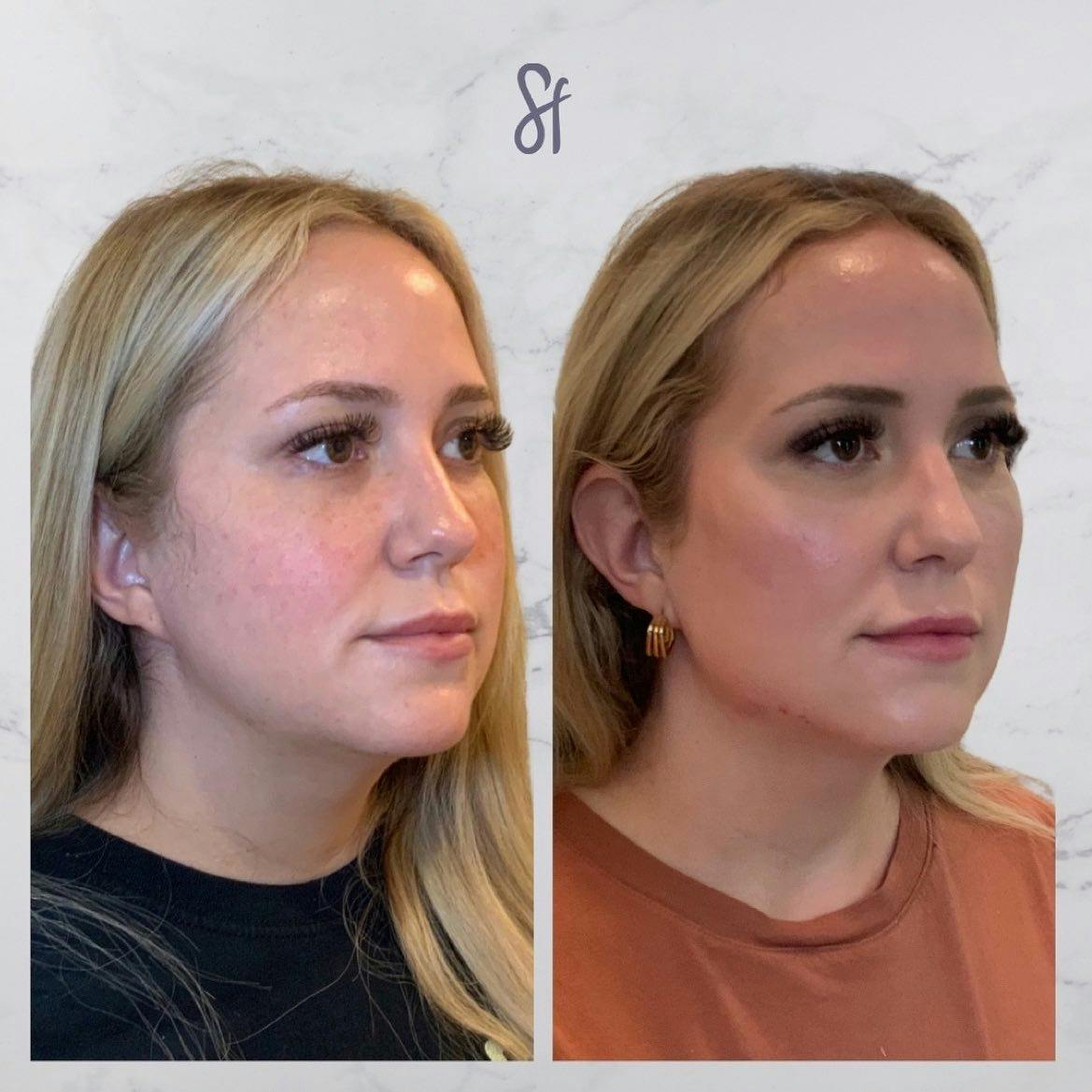 Facial Rejuvenation  Before & After Gallery - Patient 133835329 - Image 1