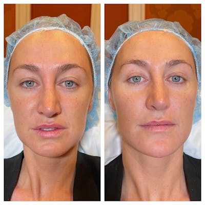 Facial Rejuvenation  Before & After Gallery - Patient 133835330 - Image 1