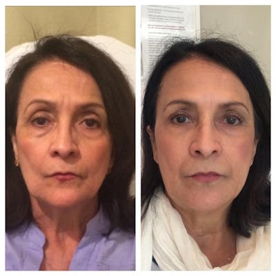 Facial Rejuvenation  Before & After Gallery - Patient 133835357 - Image 1