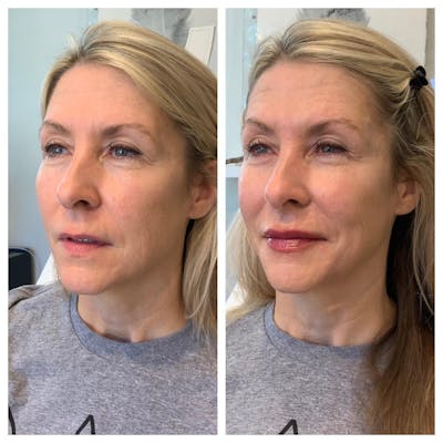 Facial Rejuvenation  Before & After Gallery - Patient 133835358 - Image 1