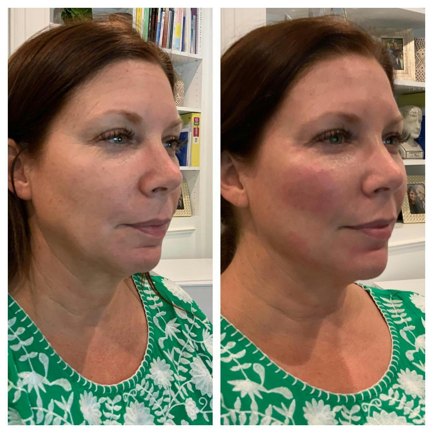 Facial Rejuvenation  Before & After Gallery - Patient 133835367 - Image 1