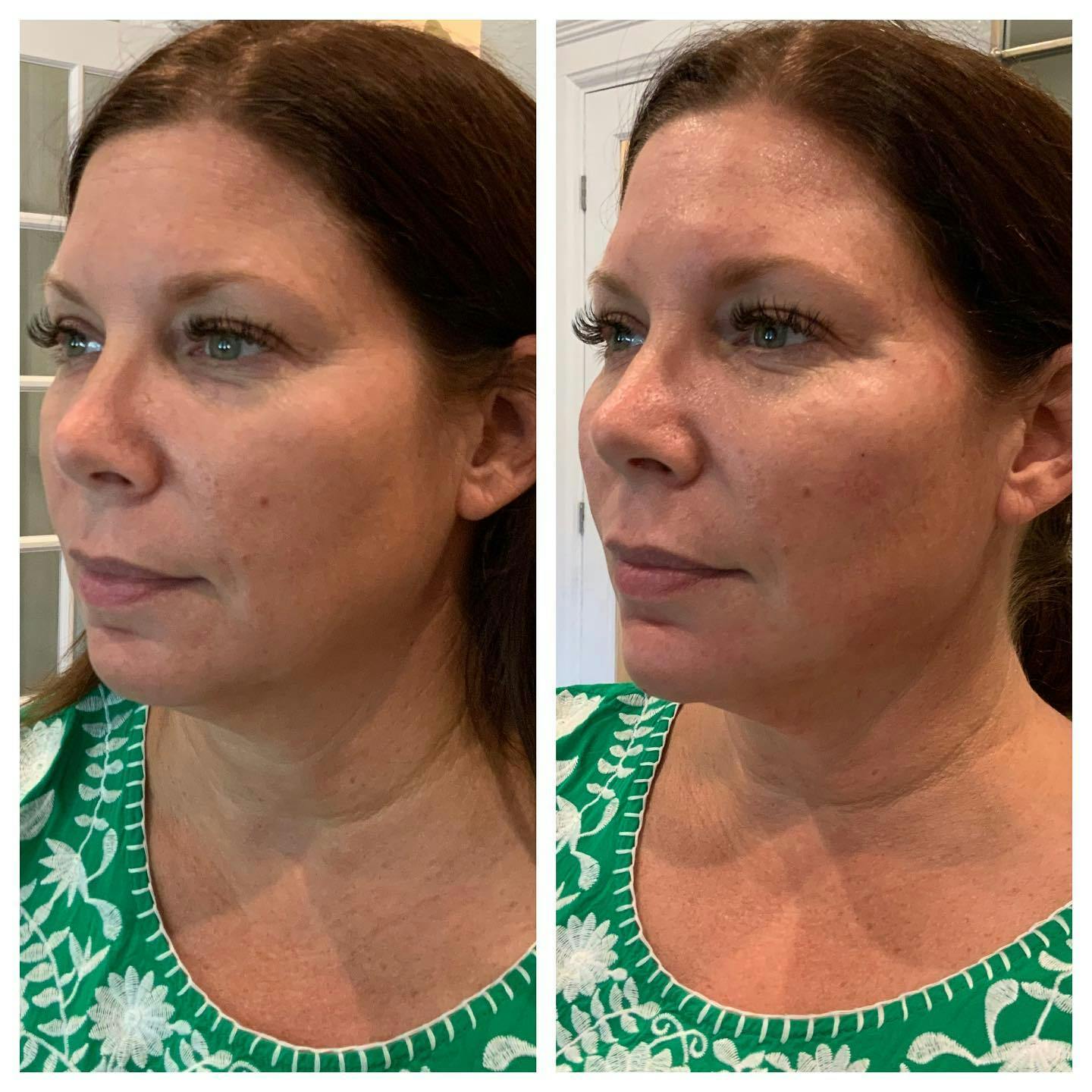 Facial Rejuvenation  Before & After Gallery - Patient 133835367 - Image 2