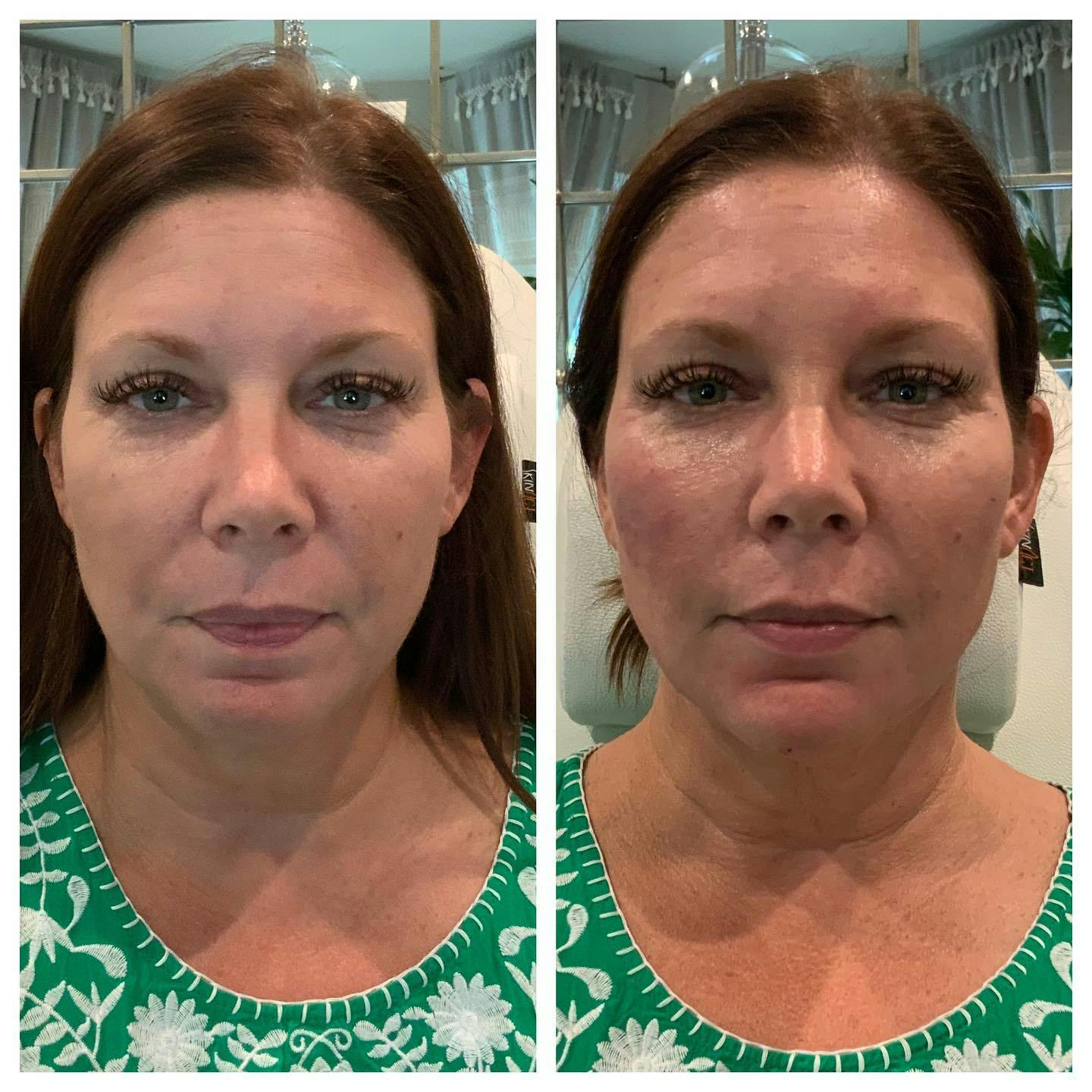 Facial Rejuvenation  Before & After Gallery - Patient 133835367 - Image 3