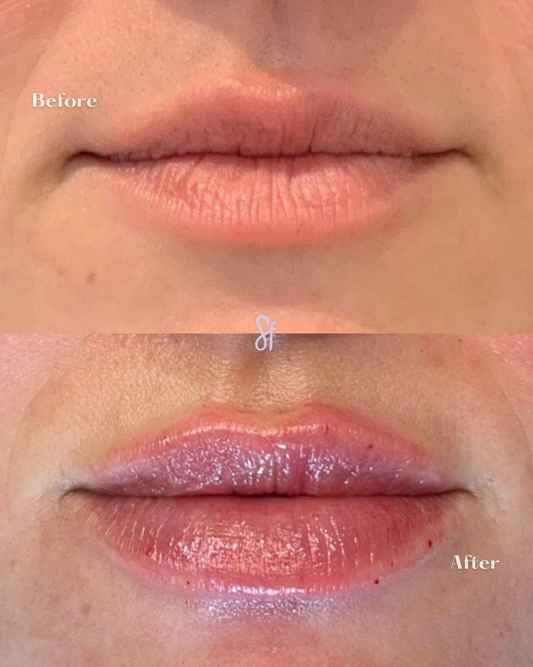 Lips Before & After Gallery - Patient 157580168 - Image 1