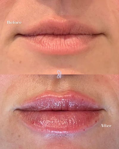 Lips Before & After Gallery - Patient 157580168 - Image 1