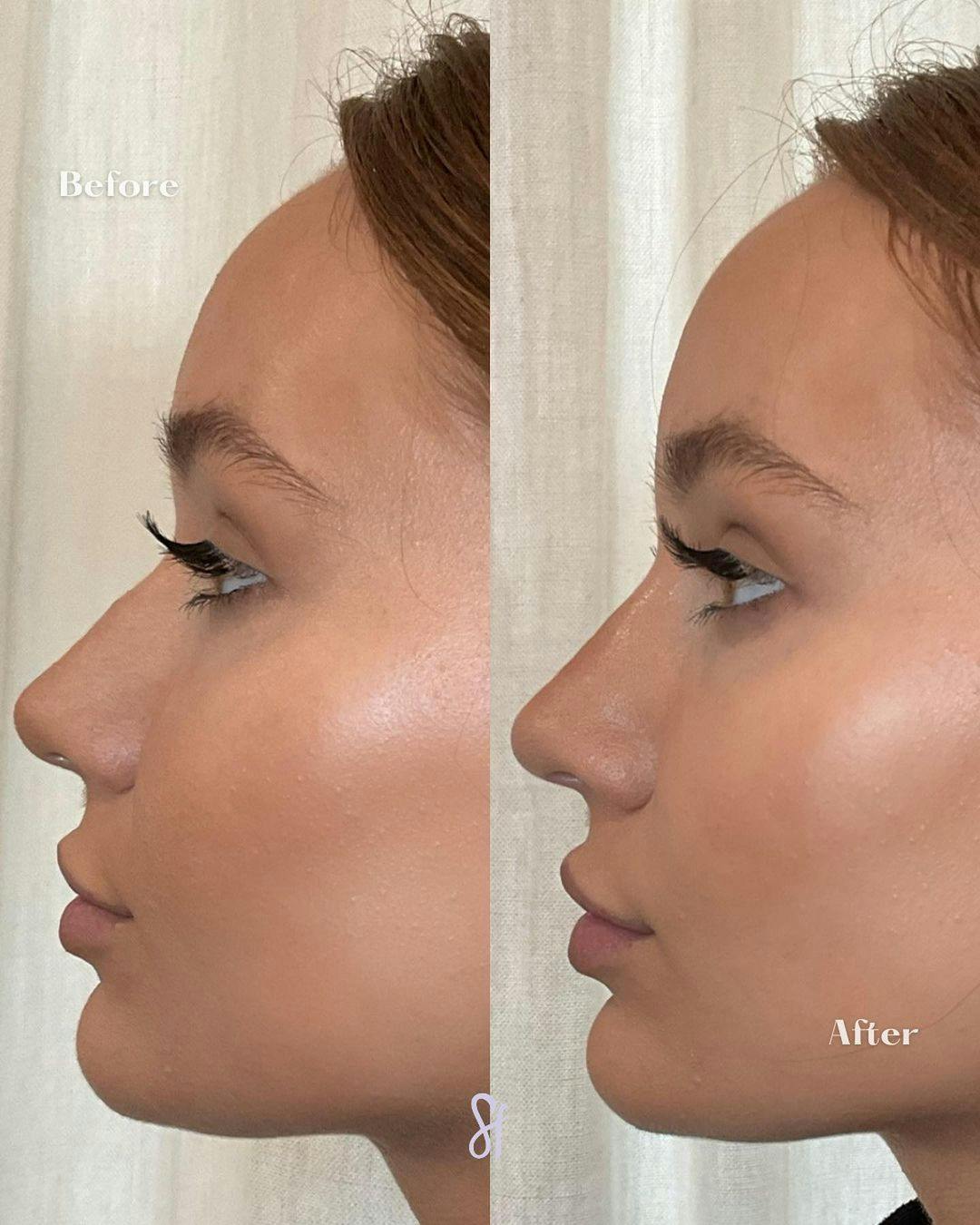 Liquid Rhinoplasty  Before & After Gallery - Patient 157580396 - Image 1