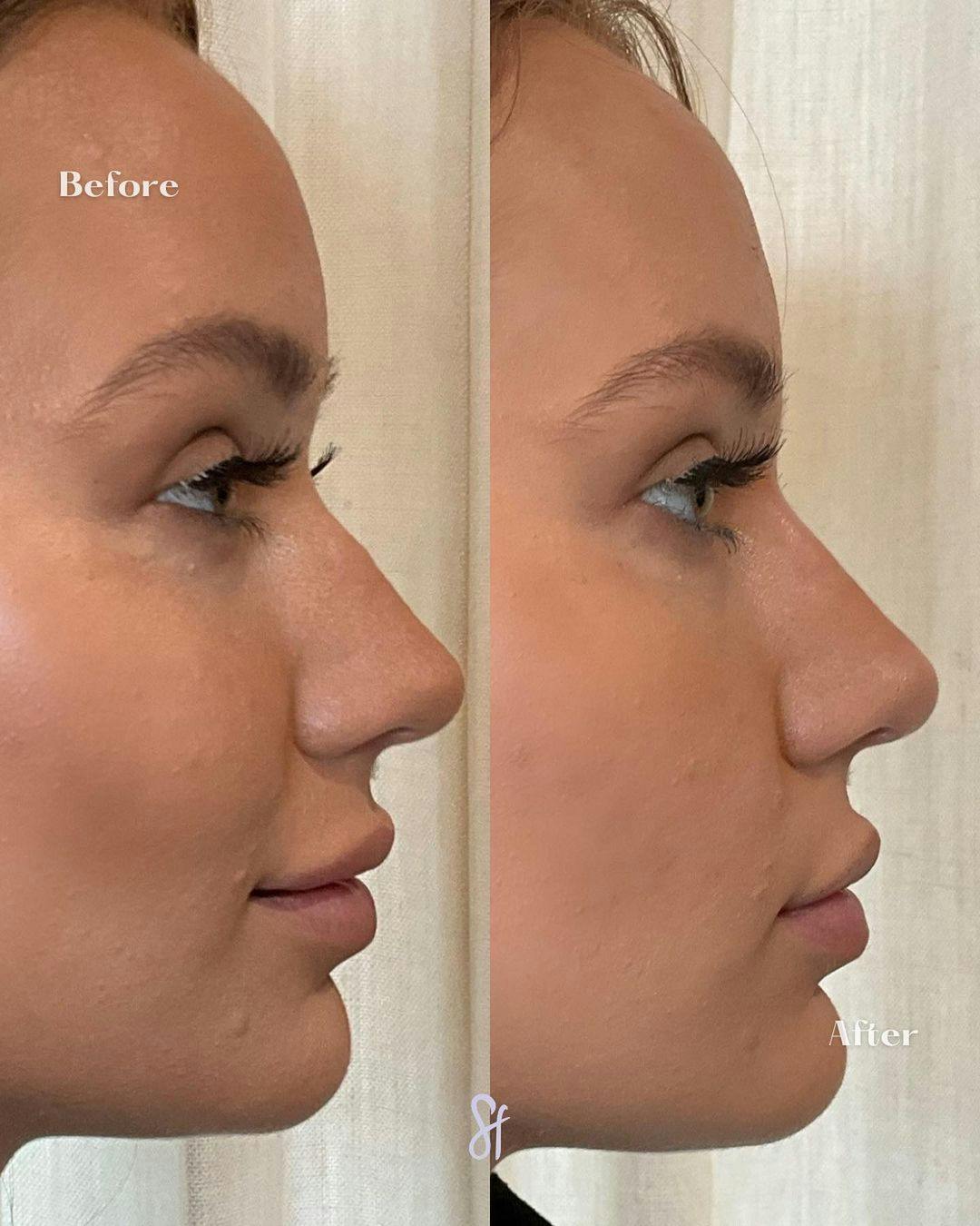 Liquid Rhinoplasty  Before & After Gallery - Patient 157580396 - Image 2