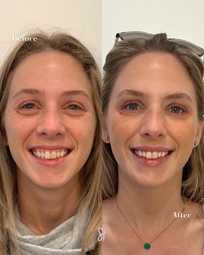Facial Rejuvenation  Before & After Gallery - Patient 157582223 - Image 1