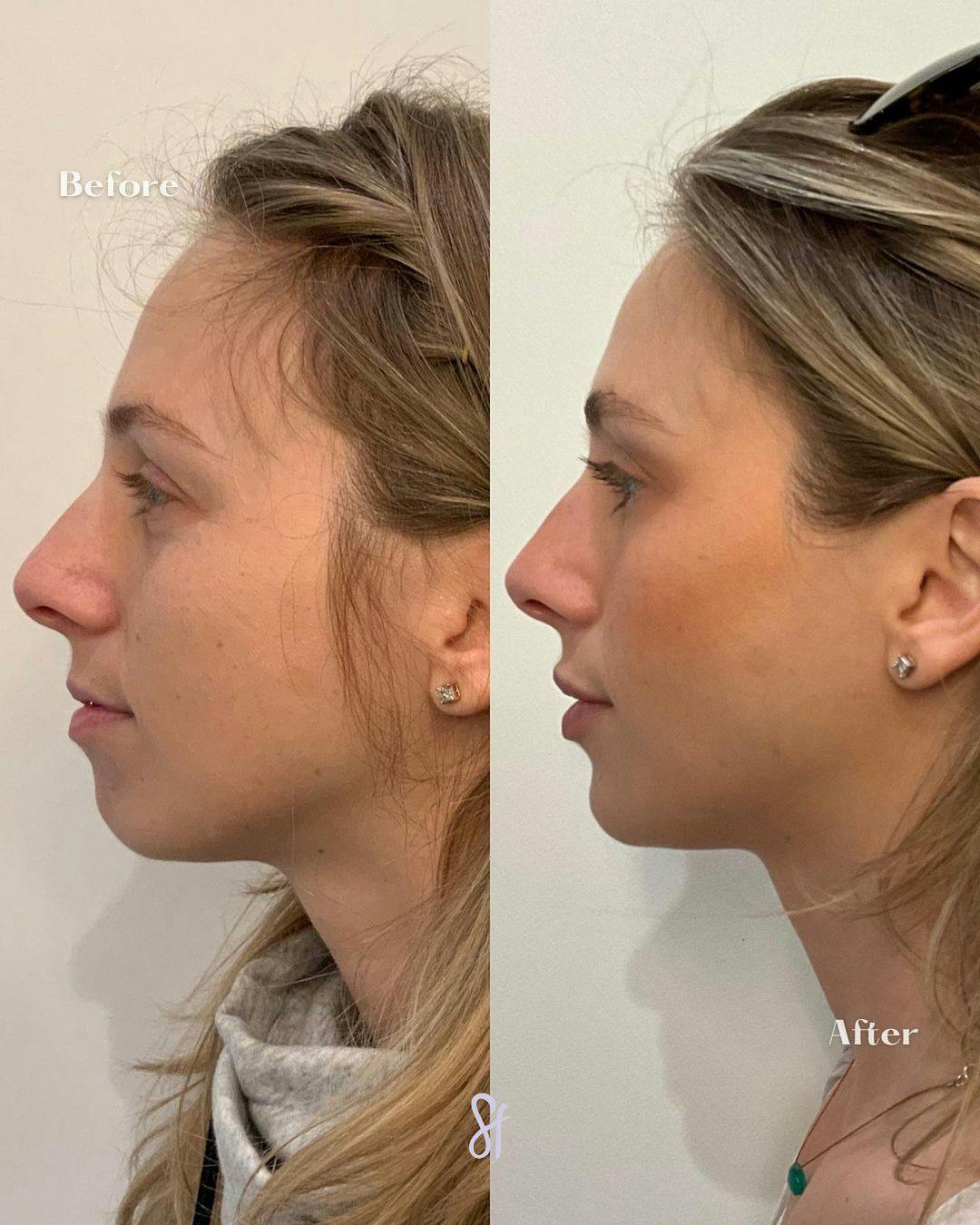 Facial Rejuvenation  Before & After Gallery - Patient 157582223 - Image 2
