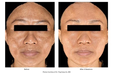 RF Microneedling Before & After Gallery - Patient 134365 - Image 1