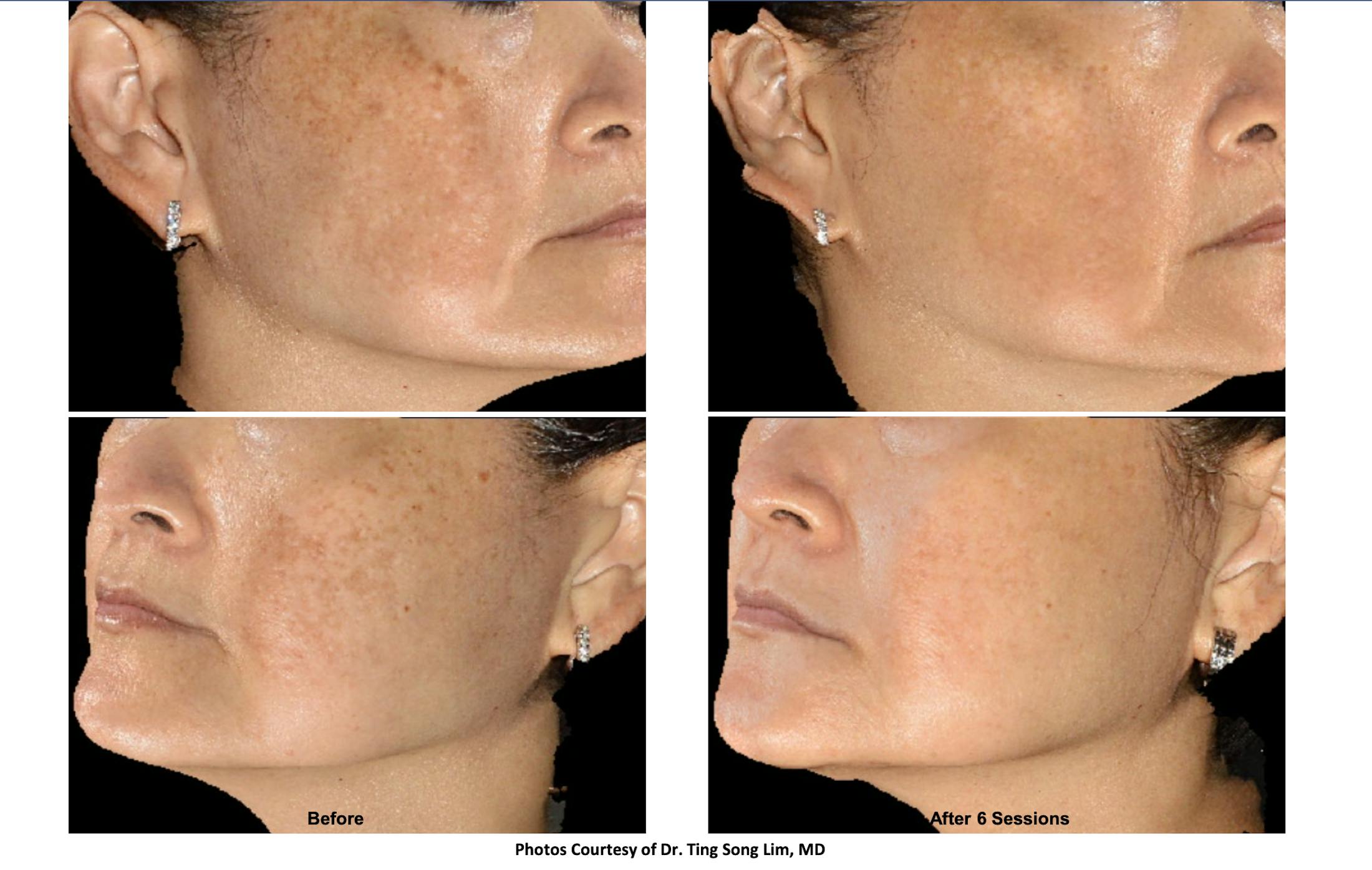 Patient 120568 RF Microneedling Before & After Photos Saving Face